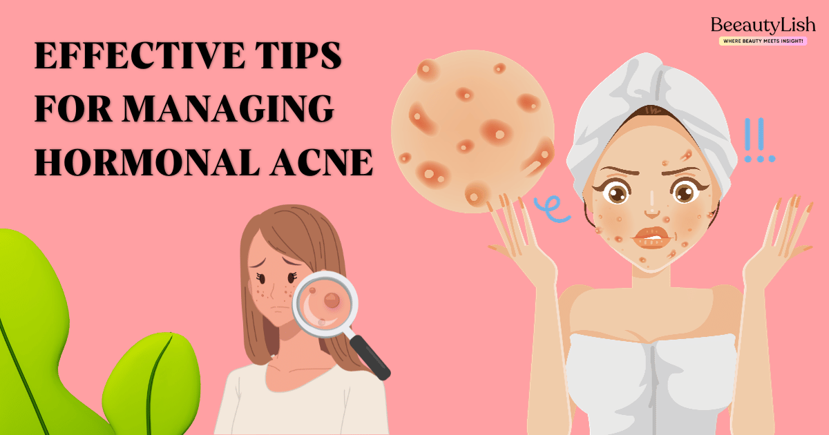  Tips for Managing Hormonal Acne 